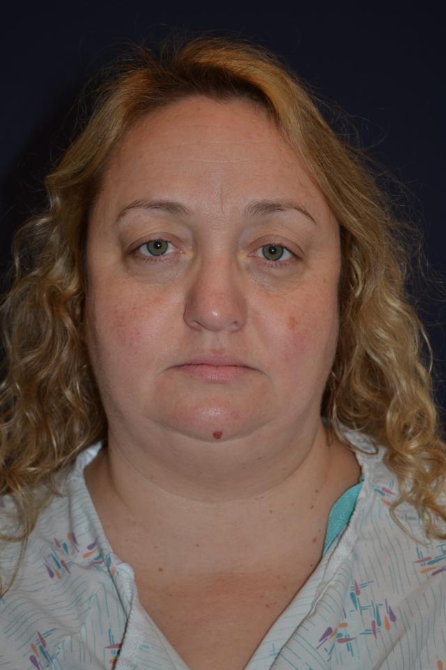 Neck Liposuction before at Dr. Adam Basner Plastic Surgery in Timonium, MD