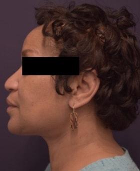 Neck Lift after at Dr. Adam Basner Plastic Surgery in Timonium, MD