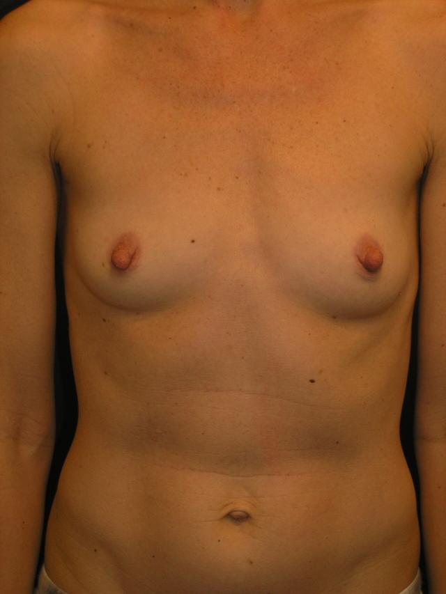 Breast Augmentation before at Dr. Adam Basner Plastic Surgery in Timonium, MD