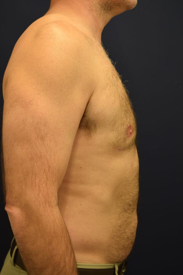 Gynecomastia Surgery after at Dr. Adam Basner Plastic Surgery in Timonium, MD