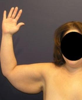 Arm Lift before at Dr. Adam Basner Plastic Surgery in Timonium, MD