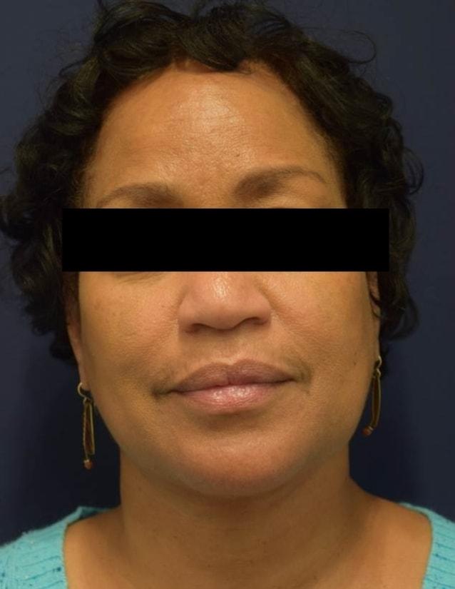 Neck Lift after at Dr. Adam Basner Plastic Surgery in Timonium, MD