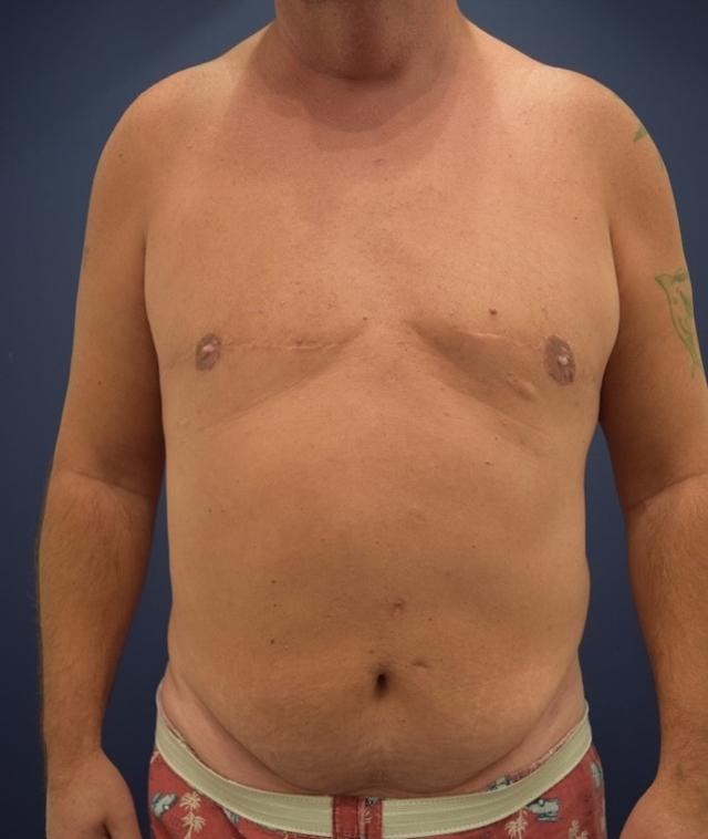Gynecomastia Surgery after at Dr. Adam Basner Plastic Surgery in Timonium, MD