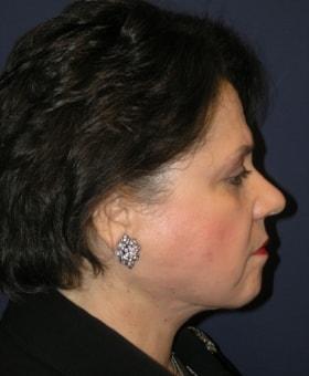 Neck Lift after at Dr. Adam Basner Plastic Surgery in Timonium, MD