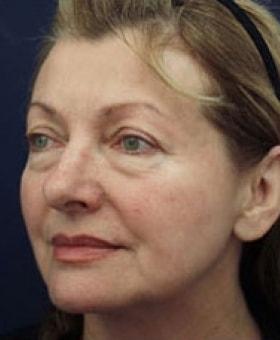Facelift before at Dr. Adam Basner Plastic Surgery in Timonium, MD
