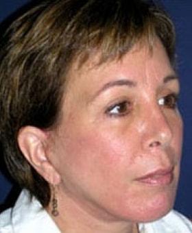 Facelift after at Dr. Adam Basner Plastic Surgery in Timonium, MD