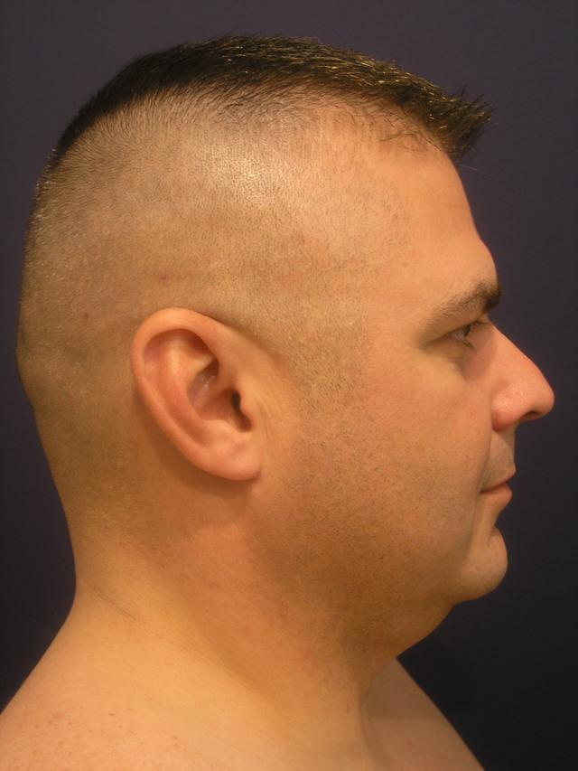 Neck Liposuction before at Dr. Adam Basner Plastic Surgery in Timonium, MD