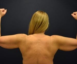Thigh Lift before at Dr. Adam Basner Plastic Surgery in Timonium, MD