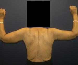 Arm Lift after at Dr. Adam Basner Plastic Surgery in Timonium, MD