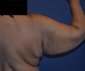 Arm Lift before at Dr. Adam Basner Plastic Surgery in Timonium, MD