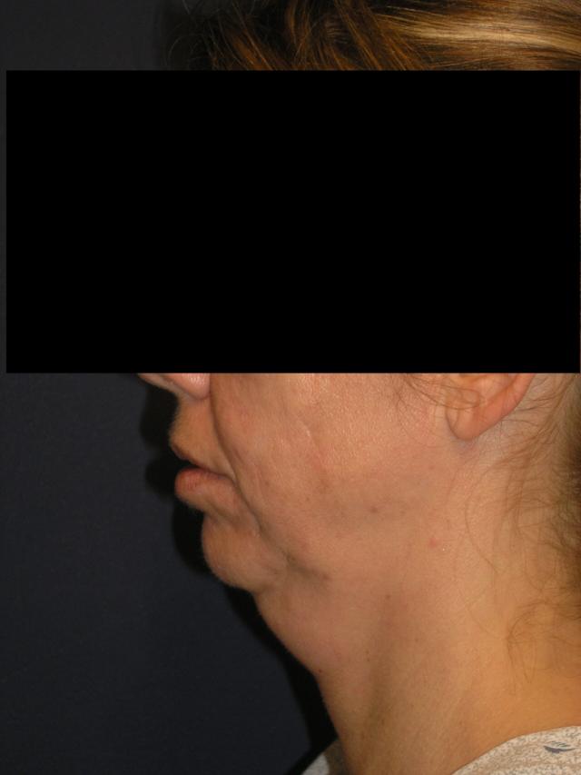 Neck Liposuction before at Dr. Adam Basner Plastic Surgery in Timonium, MD