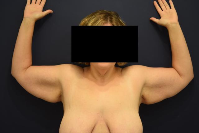 Arm Lift before at Dr. Adam Basner Plastic Surgery in Timonium, MD