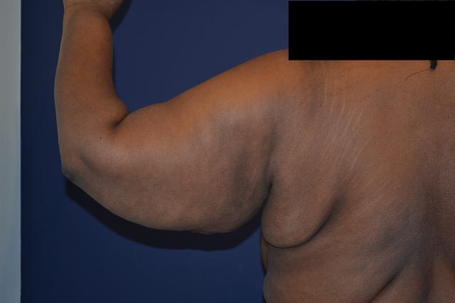 Arm Lift before at Dr. Adam Basner Plastic Surgery in Timonium, MD