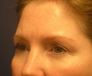 Dr. Adam Basner Plastic Surgery eyelid lift after — Timonium, MD