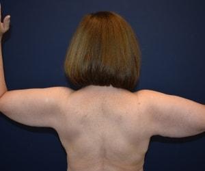 Arm Lift before at Dr. Adam Basner Plastic Surgery in Timonium, MD