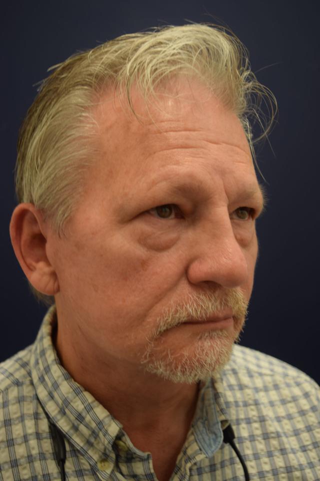 Facelift after at Dr. Adam Basner Plastic Surgery in Timonium, MD