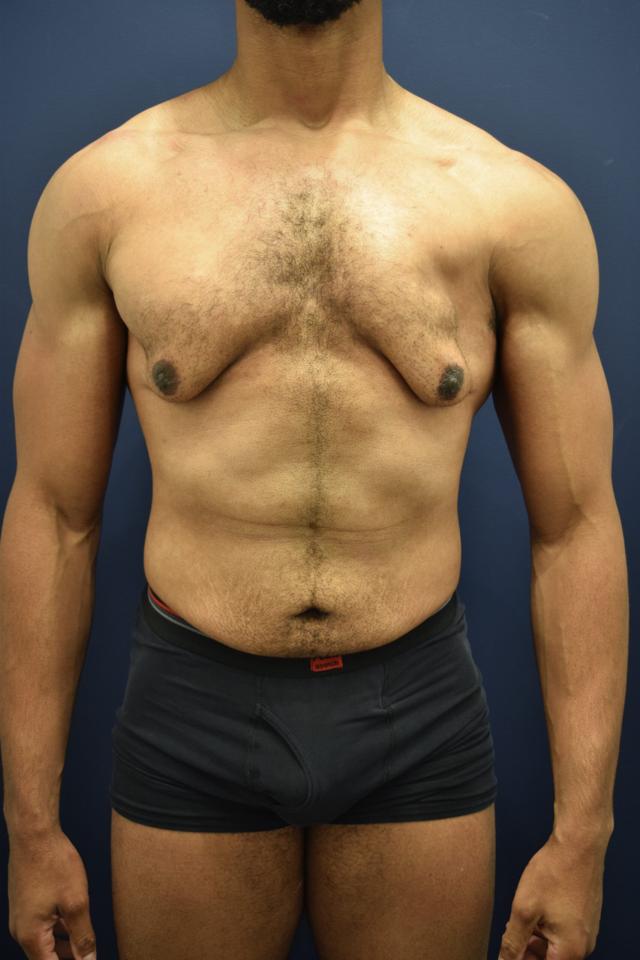 Gynecomastia Surgery before at Dr. Adam Basner Plastic Surgery in Timonium, MD