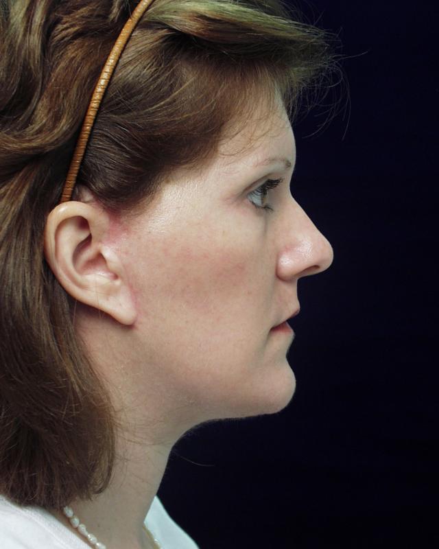 Neck Lift after at Dr. Adam Basner Plastic Surgery in Timonium, MD