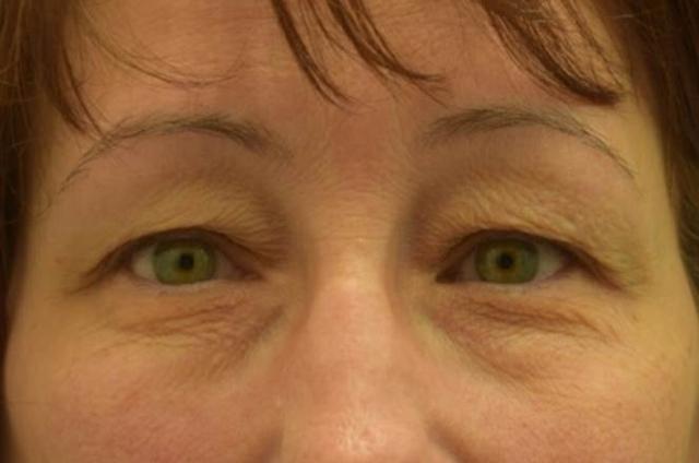 Blepharoplasty before at Dr. Adam Basner Plastic Surgery in Timonium, MD