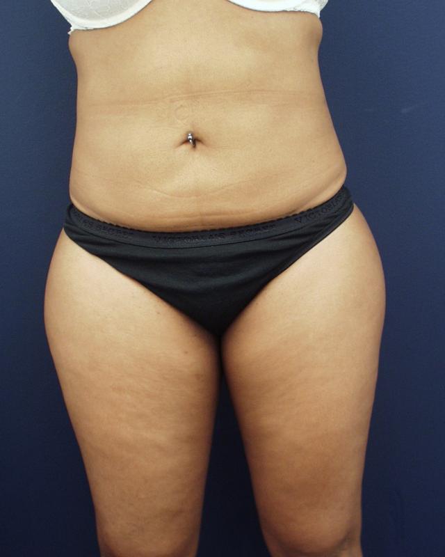 Liposuction after at Dr. Adam Basner Plastic Surgery in Timonium, MD