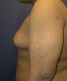 Gynecomastia Surgery before at Dr. Adam Basner Plastic Surgery in Timonium, MD