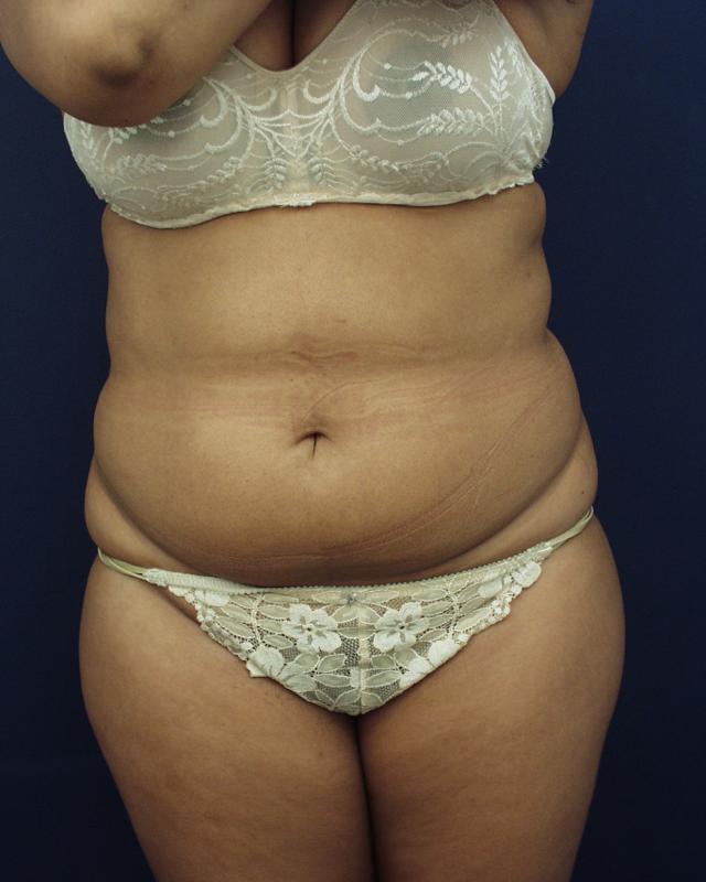 Liposuction before at Dr. Adam Basner Plastic Surgery in Timonium, MD