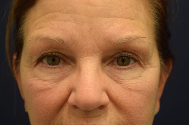Blepharoplasty before at Dr. Adam Basner Plastic Surgery in Timonium, MD