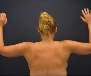 Thigh Lift after at Dr. Adam Basner Plastic Surgery in Timonium, MD