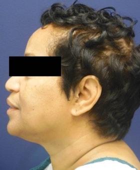 Neck Lift before at Dr. Adam Basner Plastic Surgery in Timonium, MD