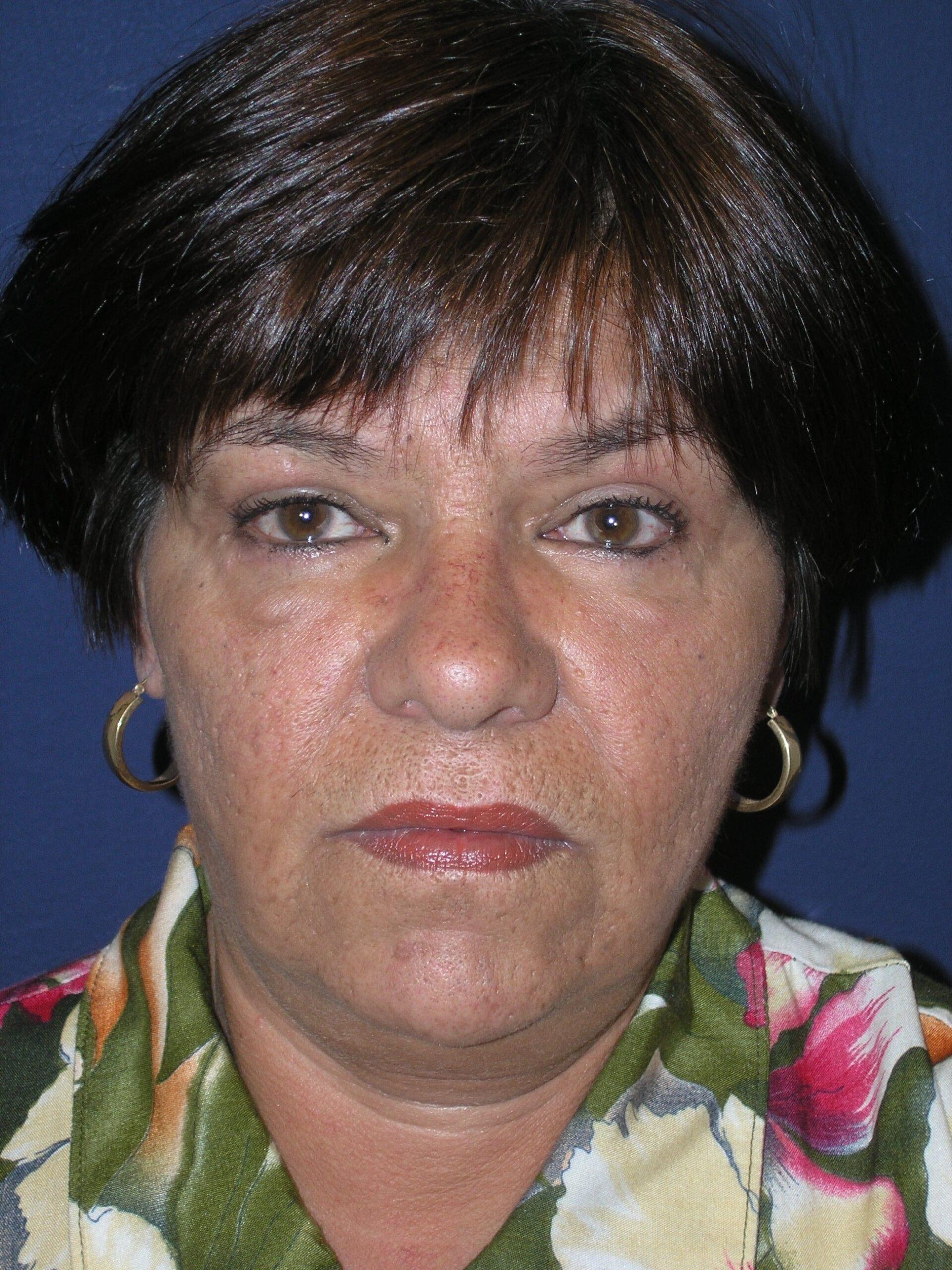 Dr. Adam Basner Plastic Surgery eyelid lift after — Timonium, MD