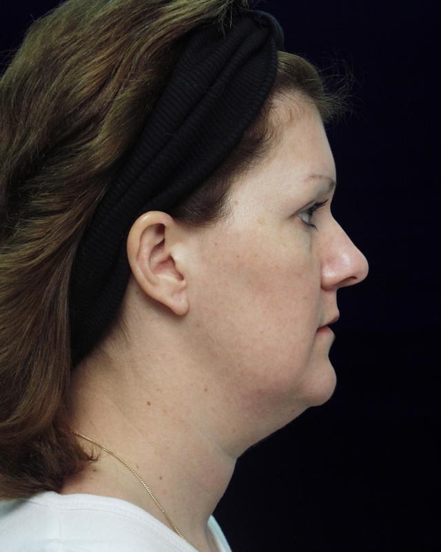 Neck Lift before at Dr. Adam Basner Plastic Surgery in Timonium, MD