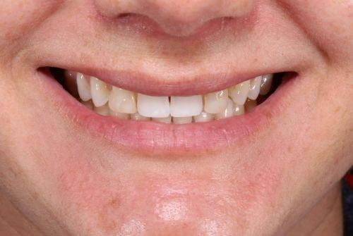 Dental Veneers before at Etesse Holistic and Cosmetic Dentistry in Solana Beach, CA