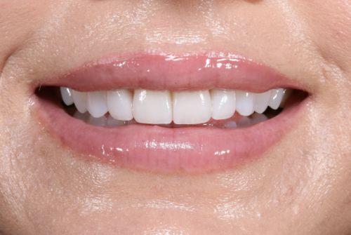Etesse Holistic and Cosmetic Dentistry veneers after — Solana Beach, CA