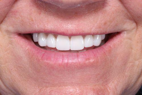 Smile Makeover after at Etesse Holistic and Cosmetic Dentistry in Solana Beach, CA