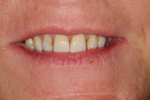 Smile Makeover before at Etesse Holistic and Cosmetic Dentistry in Solana Beach, CA