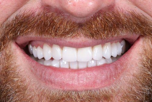 Etesse Holistic and Cosmetic Dentistry smile makeover after — Solana Beach, CA