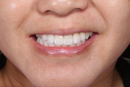Etesse Holistic and Cosmetic Dentistry veneers after — Solana Beach, CA