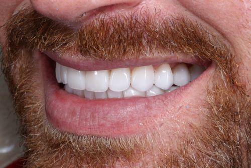 Etesse Holistic and Cosmetic Dentistry smile makeover after — Solana Beach, CA