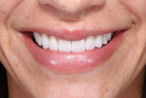 Etesse Holistic and Cosmetic Dentistry veneers after — Solana Beach, CA