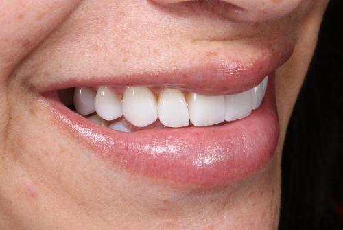 Dental Veneers after at Etesse Holistic and Cosmetic Dentistry in Solana Beach, CA
