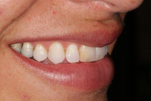 Dental Veneers before at Etesse Holistic and Cosmetic Dentistry in Solana Beach, CA
