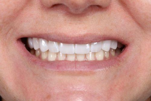 Etesse Holistic and Cosmetic Dentistry veneers after — Solana Beach, CA