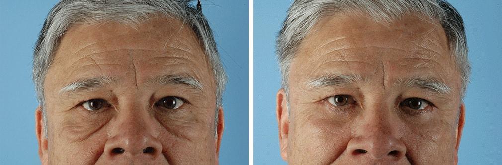 Albuquerque Center for Plastic Surgery, William G. Loutfy MD eyelid lift result — Albuquerque, NM
