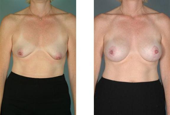 Breast Lift result at Albuquerque Center for Plastic Surgery, William G. Loutfy MD in Albuquerque, NM