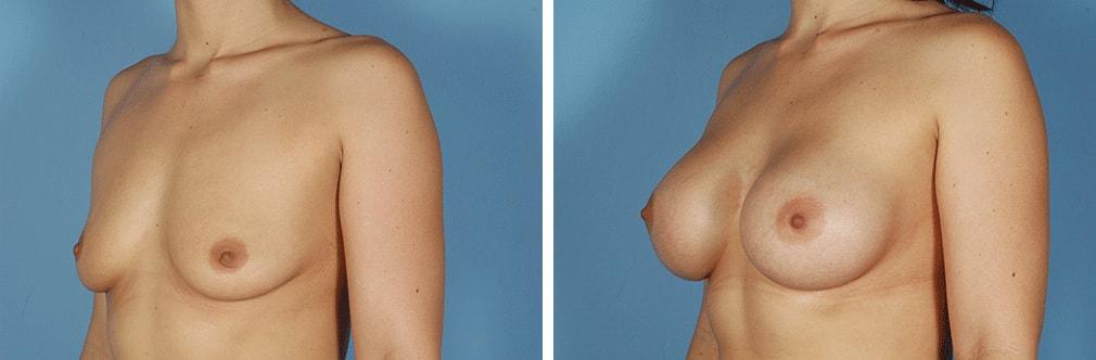 Albuquerque Center for Plastic Surgery, William G. Loutfy MD breast augmentation result — Albuquerque, NM