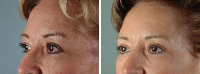 Blepharoplasty result at Albuquerque Center for Plastic Surgery, William G. Loutfy MD in Albuquerque, NM