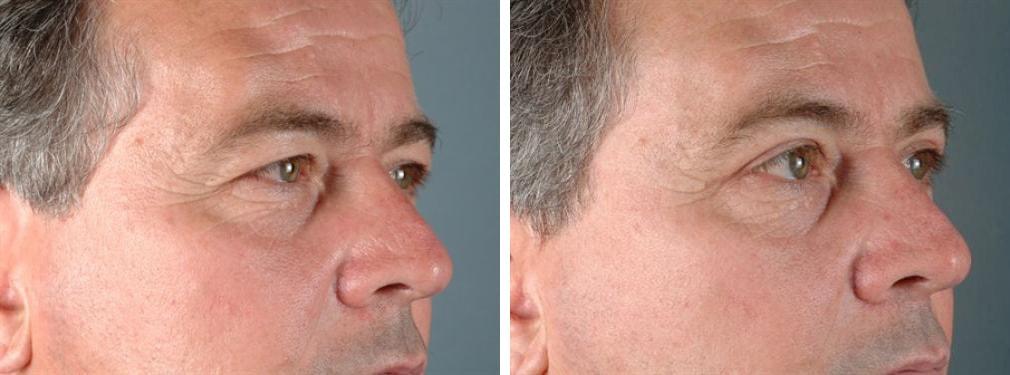 Albuquerque Center for Plastic Surgery, William G. Loutfy MD eyelid lift result — Albuquerque, NM