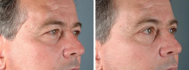 Blepharoplasty result at Albuquerque Center for Plastic Surgery, William G. Loutfy MD in Albuquerque, NM