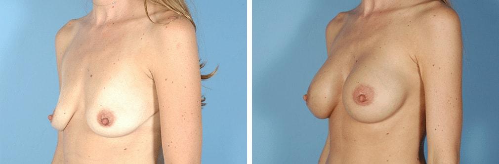 Albuquerque Center for Plastic Surgery, William G. Loutfy MD breast augmentation result — Albuquerque, NM