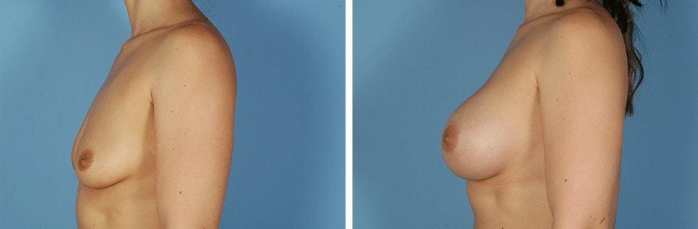 Albuquerque Center for Plastic Surgery, William G. Loutfy MD breast augmentation result — Albuquerque, NM